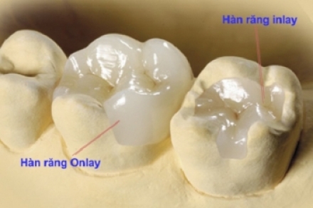 INLAY SỨ- MIẾNG TRÁM SỨ